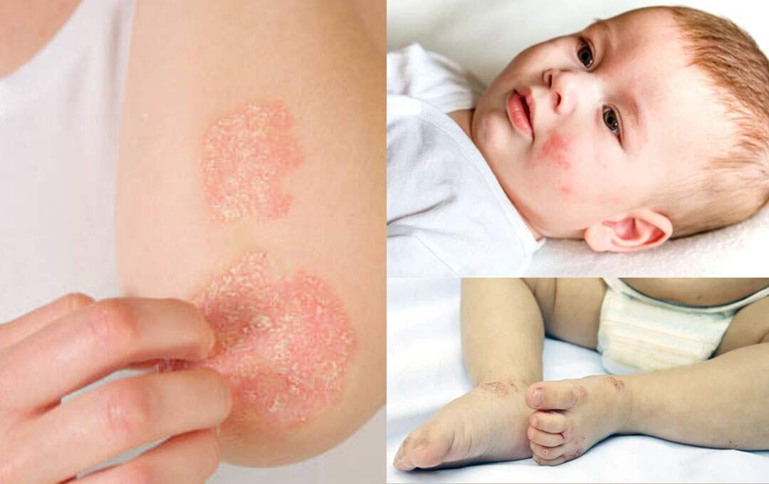 how to cure eczema permanently